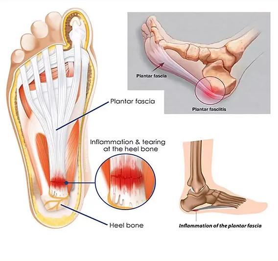 Topuk Dikeni (Plantar Fasiit)